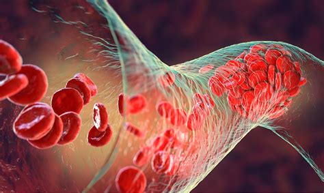 The basics of blood clots: What you need to know.